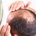 A Complete Guide to Managing Male Pattern Baldness through an Effective Hair Care Routine