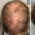 Natural Remedies for Male Pattern Baldness: Solutions for Managing and Storing Digital Content