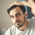 Lifestyle Changes for Preventing Male Pattern Baldness: A Comprehensive Guide