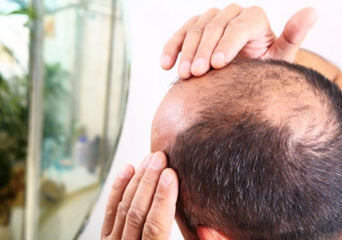 A Complete Guide to Managing Male Pattern Baldness through an Effective Hair Care Routine