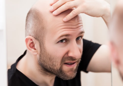 Genetics and Male Pattern Baldness: Understanding the Link