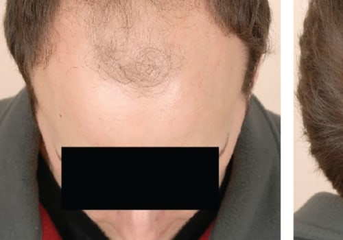 Understanding Medical Treatments for Male Pattern Baldness